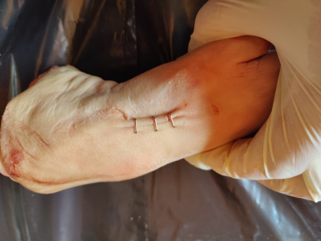 Stapled wound